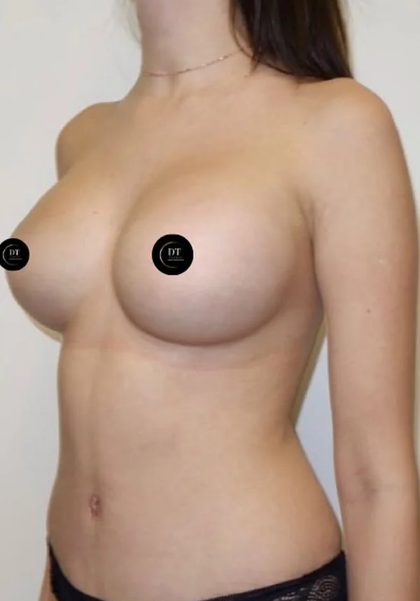 Después de aumento de pecho y abdominoplastia, vista oblicua. Caso real de DT Clinic Madrid