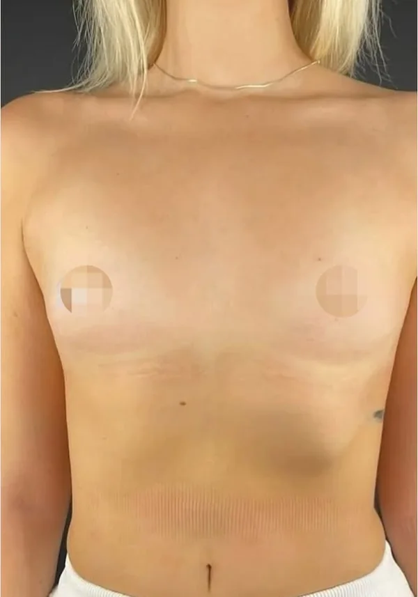 Antes de cirugía mamaria, vista frontal. Caso real de DT Clinic Madrid