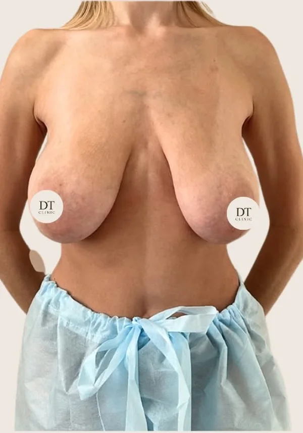 Antes de cirugía mamaria, vista frontal. Caso real de DT Clinic Madrid