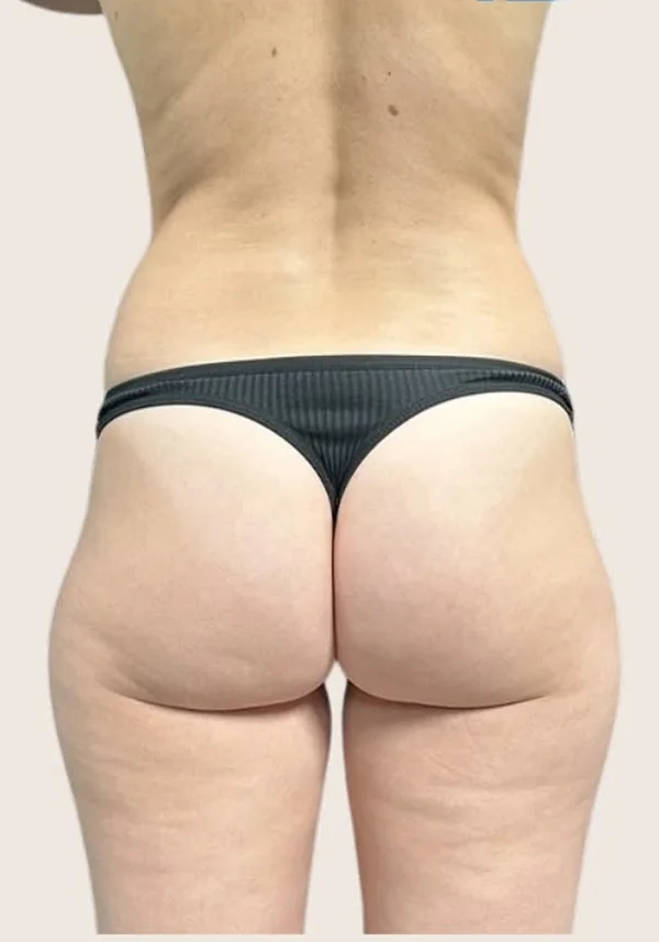 Antes de contorno corporal, vista posterior. Caso real de DT Clinic Madrid