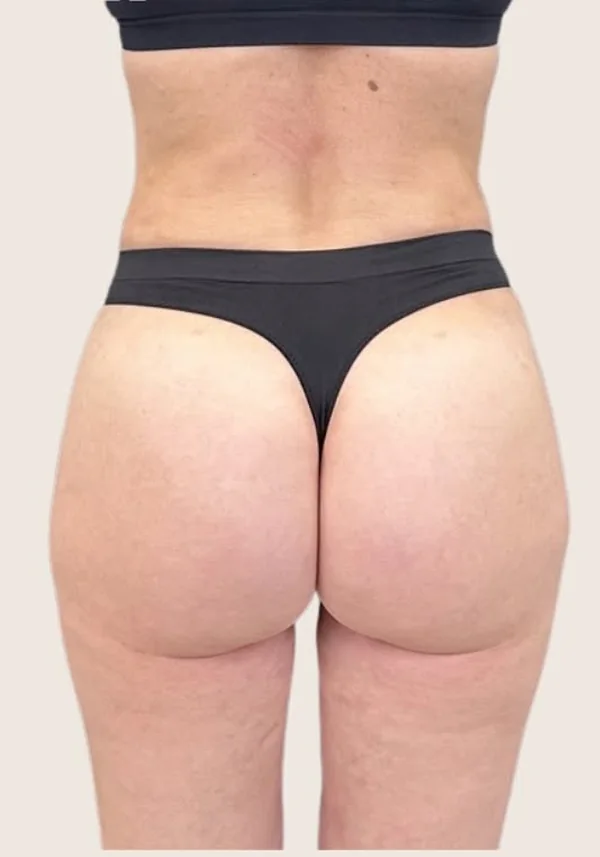 Después de contorno corporal, vista posterior. Caso real de DT Clinic Madrid