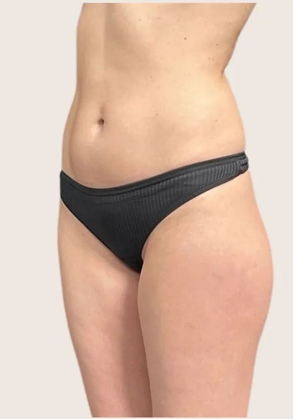 Antes de contorno corporal, vista oblicua. Caso real de DT Clinic Madrid