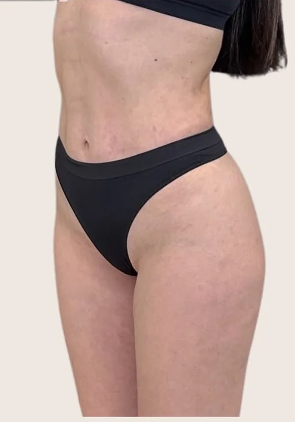Después de contorno corporal, vista oblicua. Caso real de DT Clinic Madrid