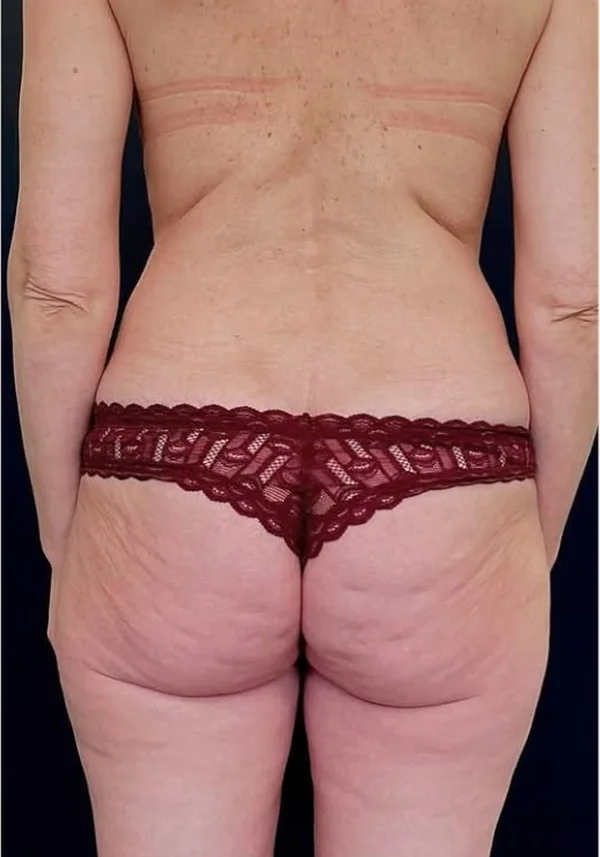 Antes de contorno corporal, vista posterior. Caso real de DT Clinic Madrid