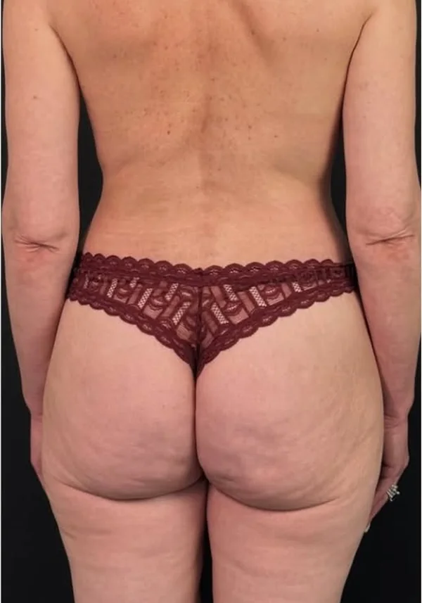 Después de contorno corporal, vista posterior. Caso real de DT Clinic Madrid