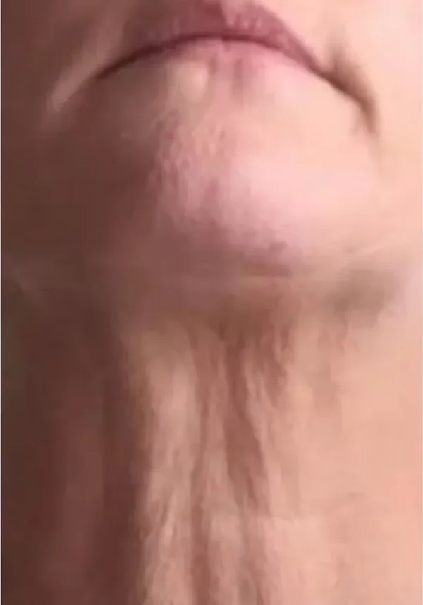 Antes de lifting cervicofacial, cuello, vista frontal. Caso real de DT Clinic Madrid