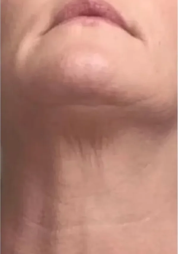 Después de lifting cervicofacial, cuello, vista frontal. Caso real de DT Clinic Madrid