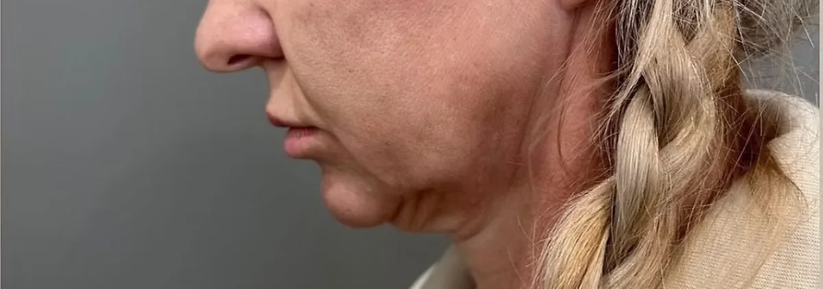 Antes de lifting facial, perfil. Caso real de DT Clinic Madrid