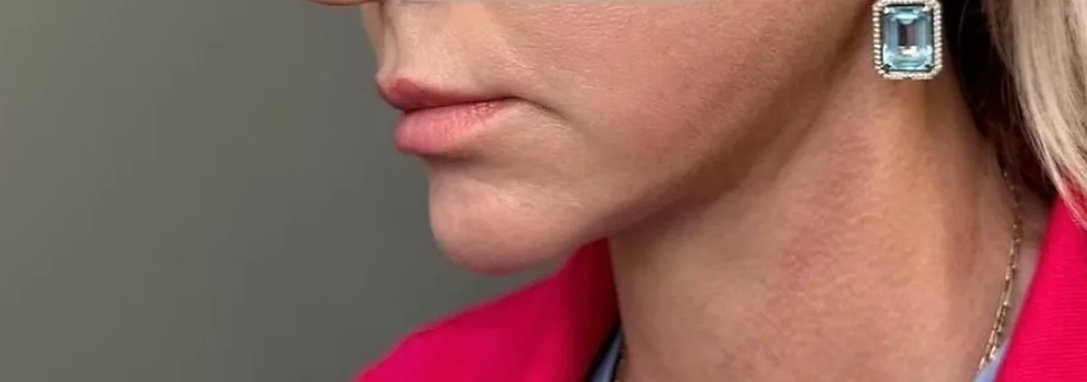 Después de lifting facial, perfil. Caso real de DT Clinic Madrid