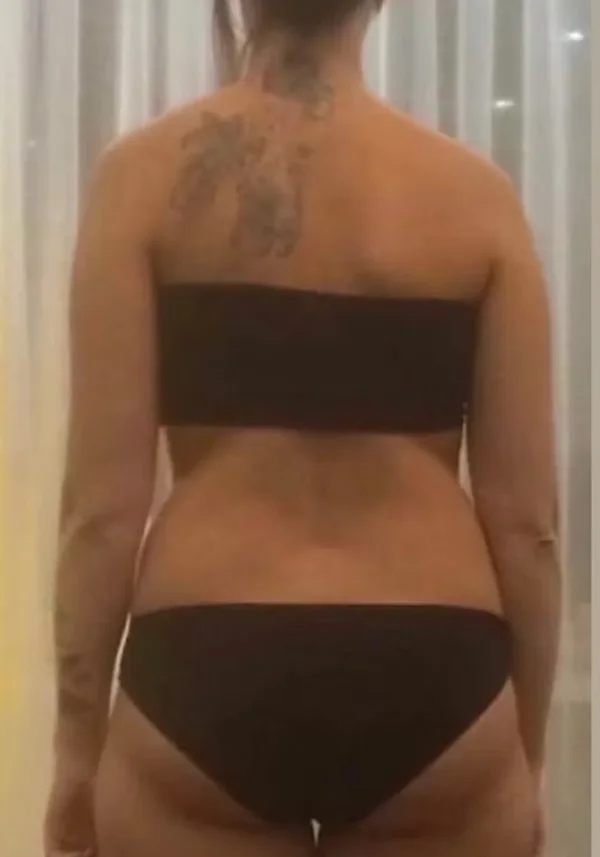 Antes de liposucción con BBL, vista posterior. Caso real de DT Clinic Madrid