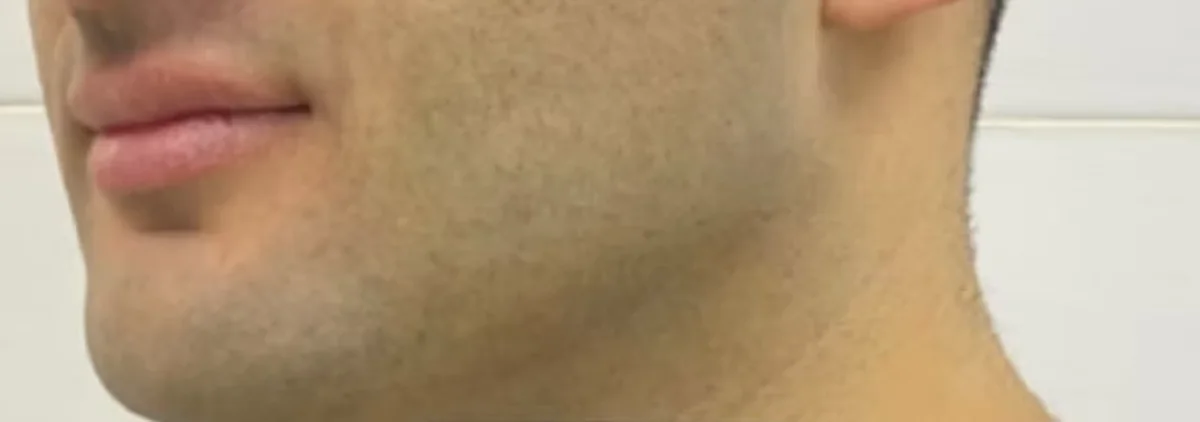 Antes de liposucción de papada, perfil. Caso real de DT Clinic Madrid