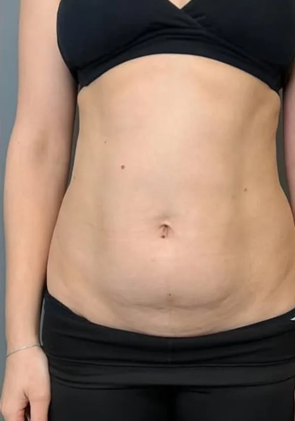 Antes de liposucción y miniabdominoplastia, vista frontal. Caso real de DT Clinic Madrid