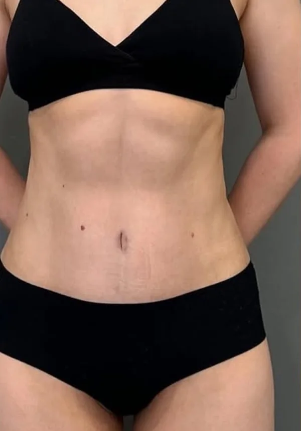 Después de liposucción y miniabdominoplastia, vista frontal. Caso real de DT Clinic Madrid