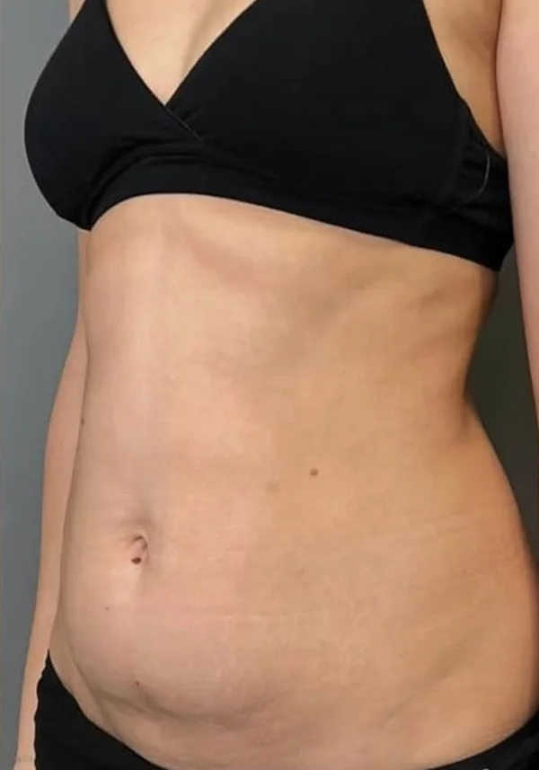 Antes de liposucción y miniabdominoplastia, vista oblicua. Caso real de DT Clinic Madrid