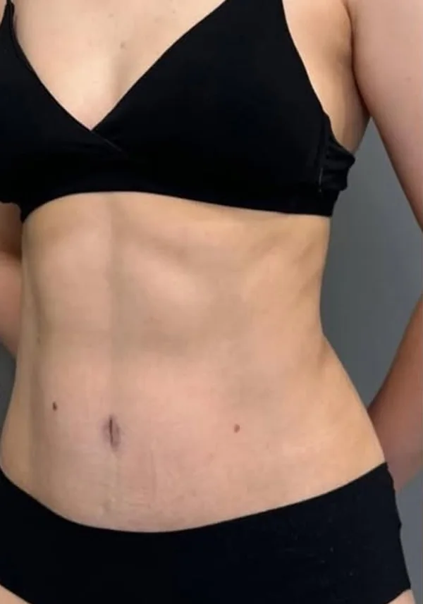 Después de liposucción y miniabdominoplastia, vista oblicua. Caso real de DT Clinic Madrid