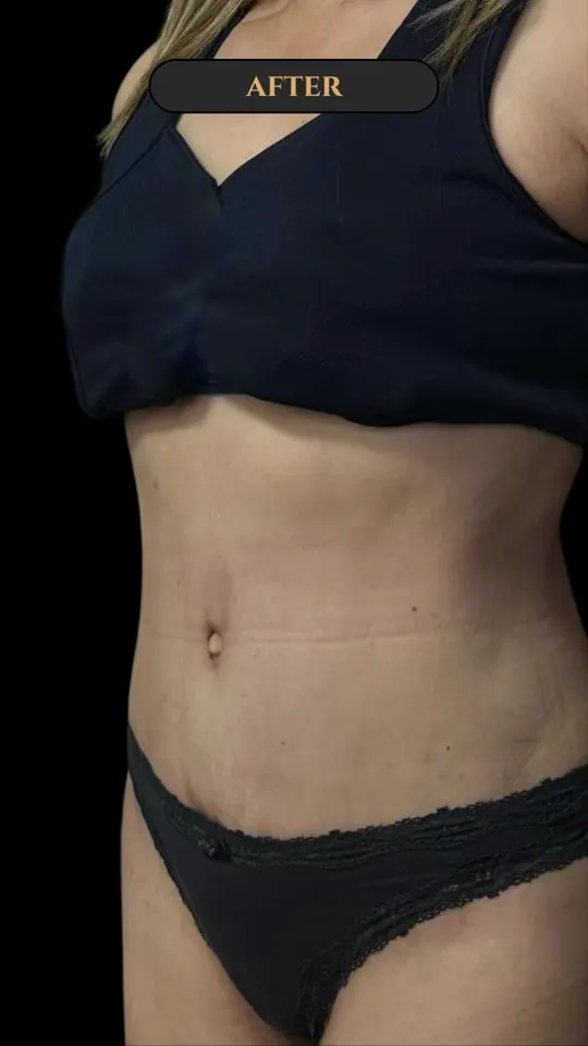 Abdominoplastia: antes y después de un caso real
