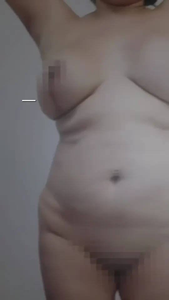 Abdominoplastia en quirófano: antes y después