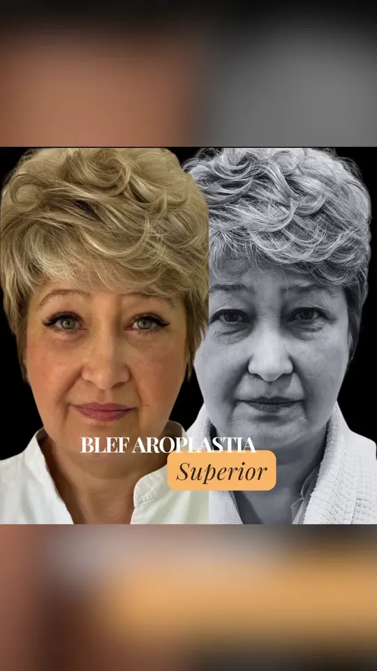 Blefaroplastia superior: antes y después de un caso real