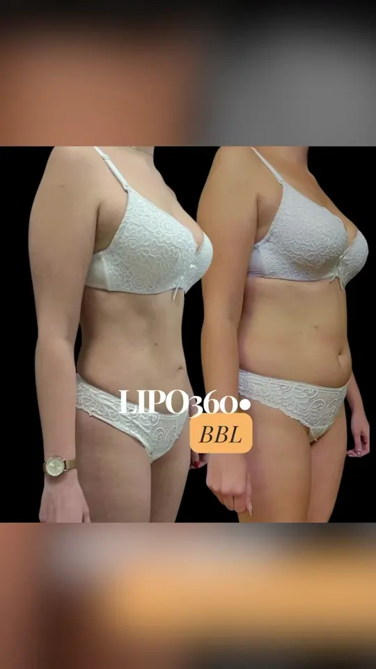 Lipo 360 con BBL: antes y después de un caso real