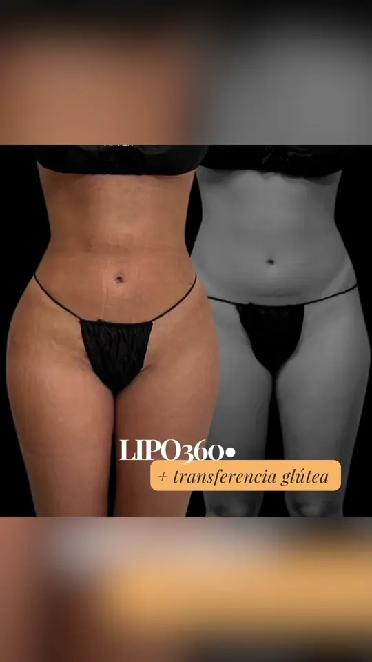 Lipo 360 con transferencia glútea: antes y después