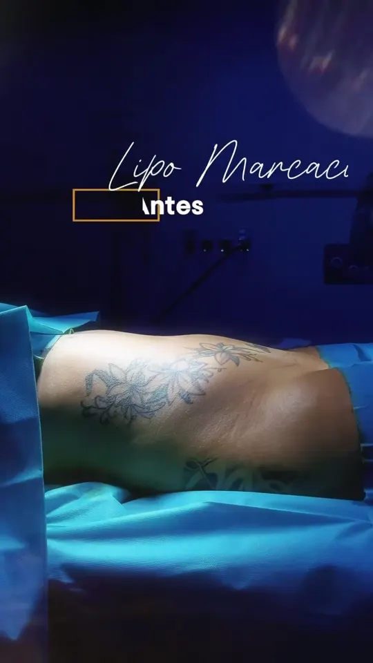 Lipomarcación: antes y después en quirófano