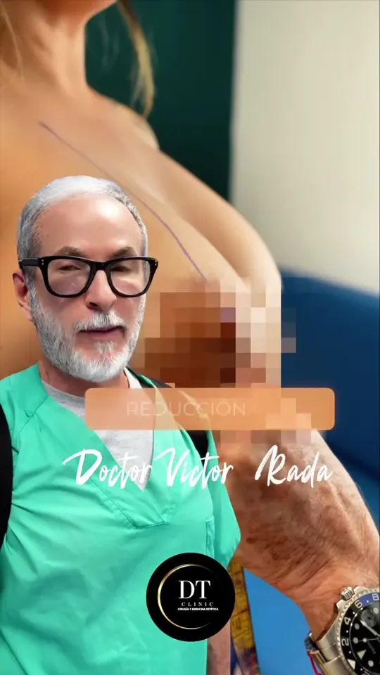 Reducción de pecho en Madrid con el Dr. Víctor Rada