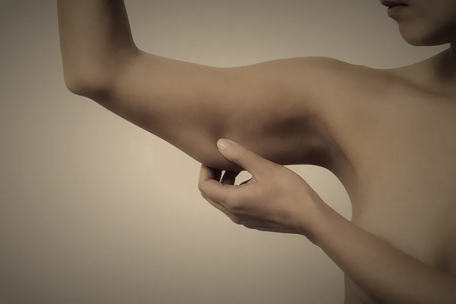 Brazos finos y firmes con vestido de tirantes tras un lifting de brazos en DT Clinic Madrid